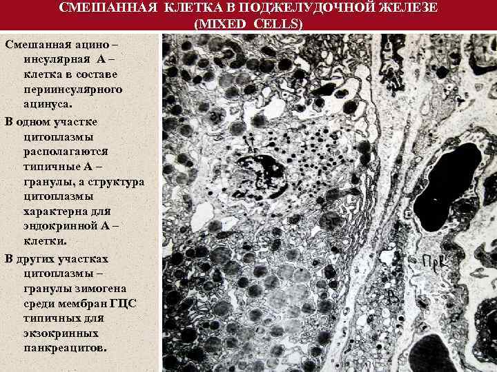 СМЕШАННАЯ КЛЕТКА В ПОДЖЕЛУДОЧНОЙ ЖЕЛЕЗЕ (MIXED CELLS) Смешанная ацино – инсулярная А – клетка