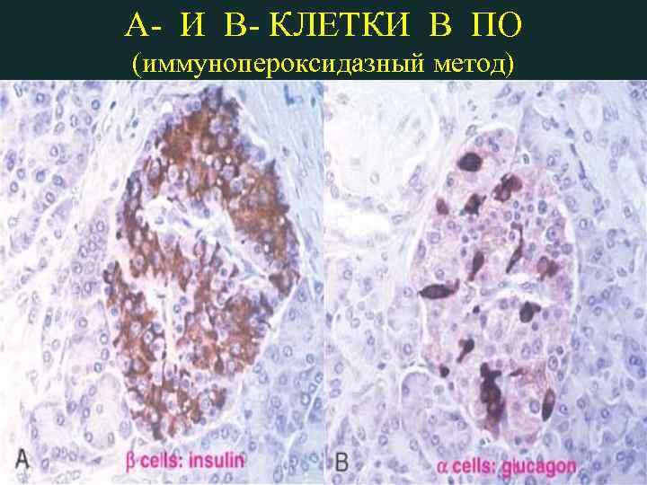 A- И B- КЛЕТКИ В ПО (иммунопероксидазный метод) 