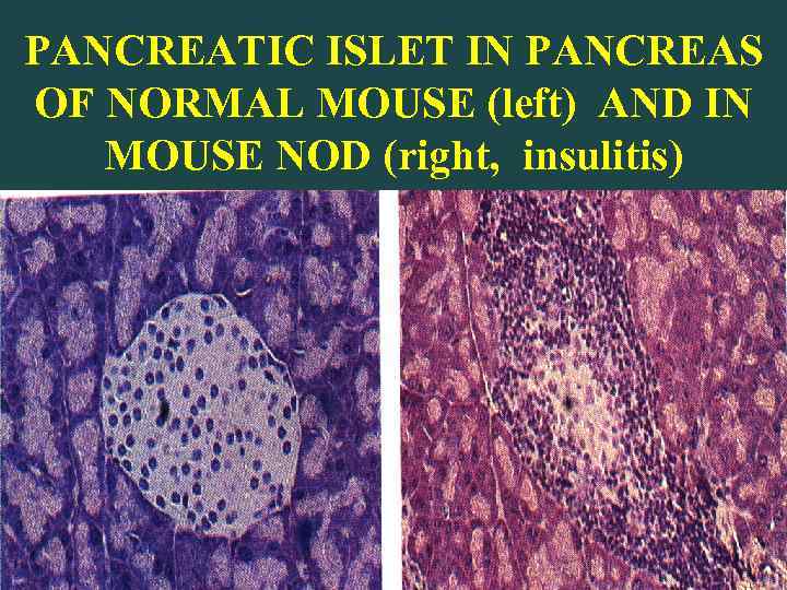 PANCREATIC ISLET IN PANCREAS OF NORMAL MOUSE (left) AND IN MOUSE NOD (right, insulitis)