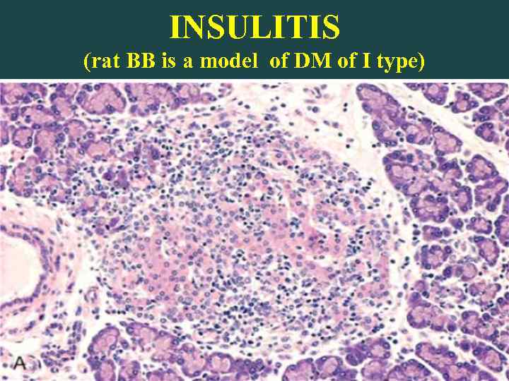 INSULITIS (rat BB is a model of DM of I type) 