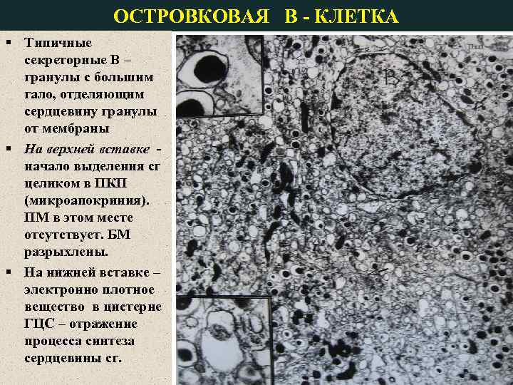 ОСТРОВКОВАЯ В - КЛЕТКА § Типичные секреторные В – гранулы с большим гало, отделяющим