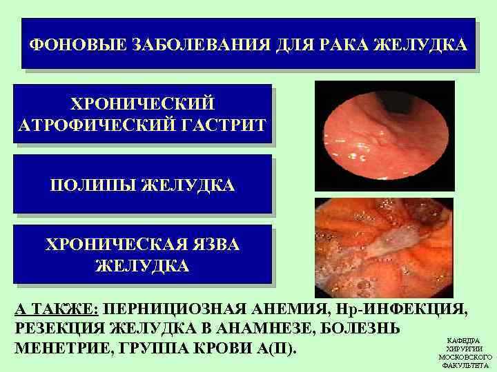 ФОНОВЫЕ ЗАБОЛЕВАНИЯ ДЛЯ РАКА ЖЕЛУДКА ХРОНИЧЕСКИЙ АТРОФИЧЕСКИЙ ГАСТРИТ ПОЛИПЫ ЖЕЛУДКА ХРОНИЧЕСКАЯ ЯЗВА ЖЕЛУДКА А