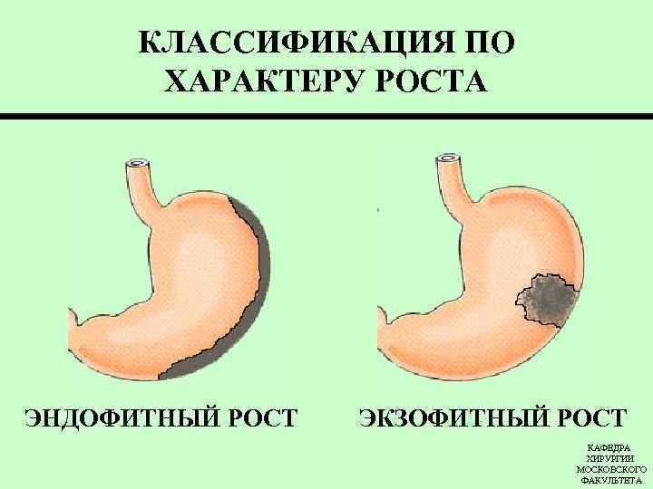 КЛАССИФИКАЦИЯ ПО ХАРАКТЕРУ РОСТА ЭНДОФИТНЫЙ РОСТ ЭКЗОФИТНЫЙ РОСТ КАФЕДРА ХИРУРГИИ МОСКОВСКОГО ФАКУЛЬТЕТА 