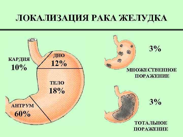 ЛОКАЛИЗАЦИЯ РАКА ЖЕЛУДКА КАРДИЯ 10% ДНО 12% 3% МНОЖЕСТВЕННОЕ ПОРАЖЕНИЕ ТЕЛО 18% АНТРУМ 3%