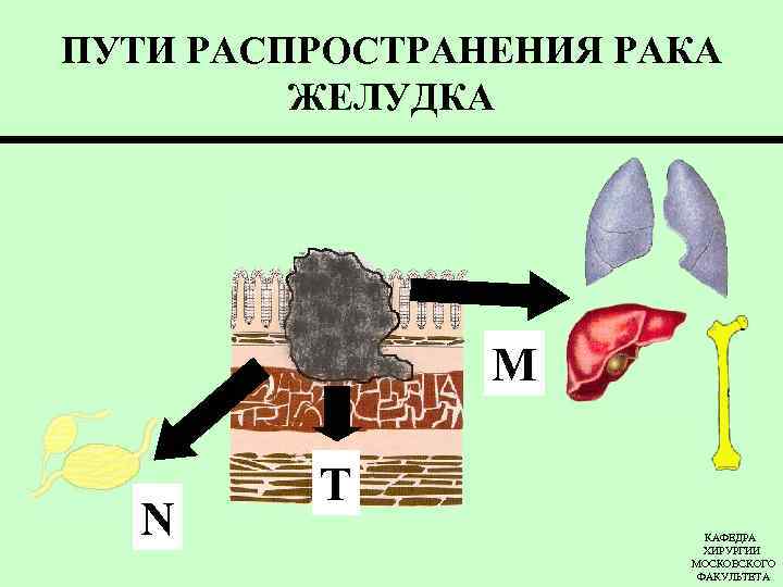 ПУТИ РАСПРОСТРАНЕНИЯ РАКА ЖЕЛУДКА М N Т КАФЕДРА ХИРУРГИИ МОСКОВСКОГО ФАКУЛЬТЕТА 