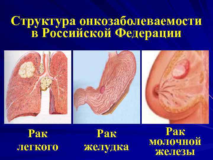 Структура онкозаболеваемости в Российской Федерации Рак легкого Рак желудка Рак молочной железы 