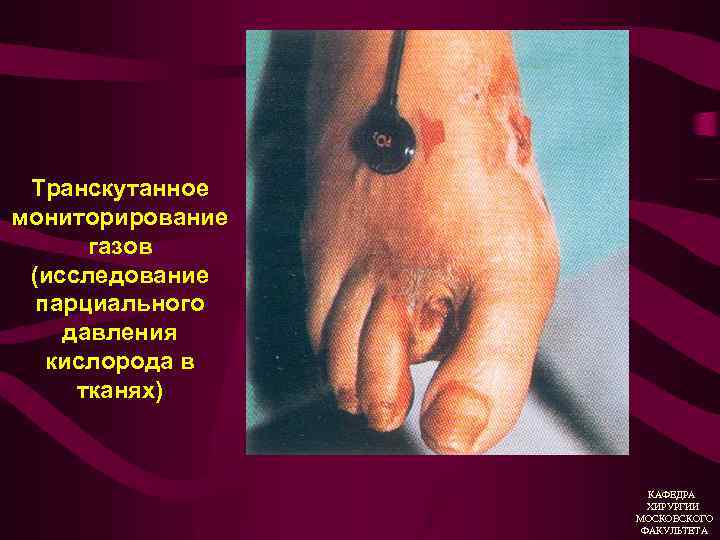 Транскутанное мониторирование газов (исследование парциального давления кислорода в тканях) КАФЕДРА ХИРУРГИИ МОСКОВСКОГО ФАКУЛЬТЕТА 