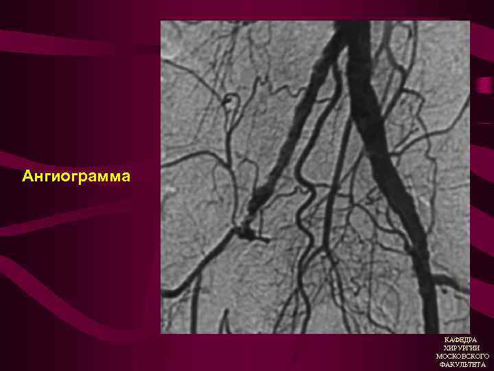Ангиограмма КАФЕДРА ХИРУРГИИ МОСКОВСКОГО ФАКУЛЬТЕТА 
