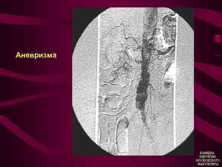 Аневризма КАФЕДРА ХИРУРГИИ МОСКОВСКОГО ФАКУЛЬТЕТА 
