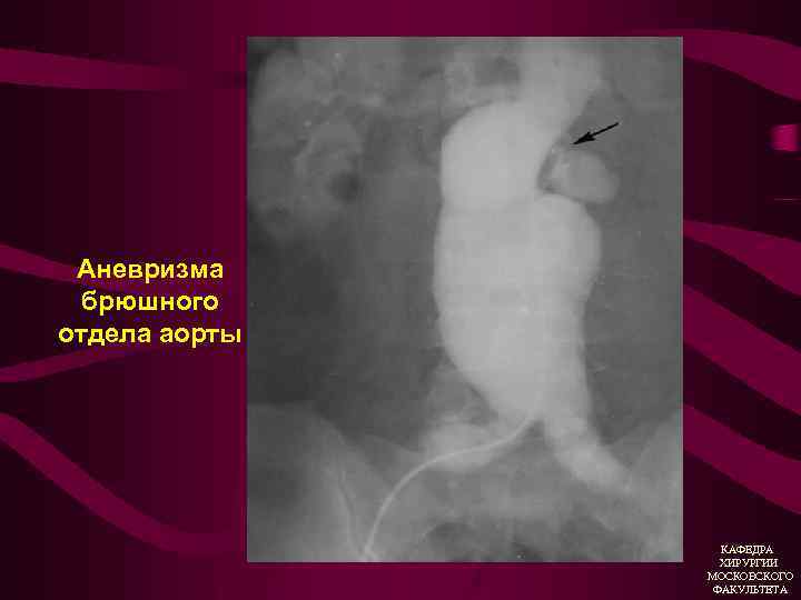 Аневризма брюшного отдела аорты КАФЕДРА ХИРУРГИИ МОСКОВСКОГО ФАКУЛЬТЕТА 