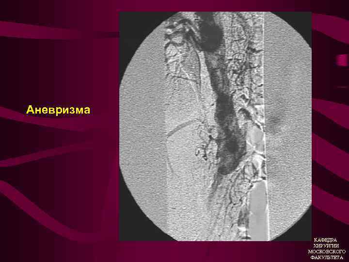 Аневризма КАФЕДРА ХИРУРГИИ МОСКОВСКОГО ФАКУЛЬТЕТА 