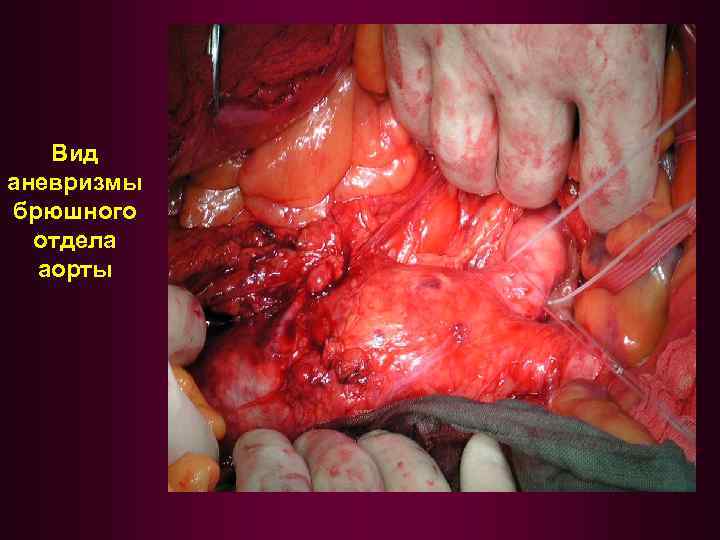Вид аневризмы брюшного отдела аорты 