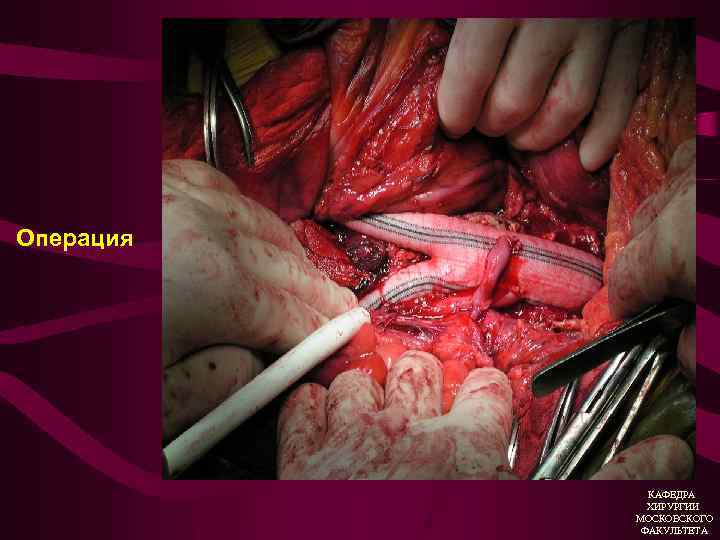 Операция КАФЕДРА ХИРУРГИИ МОСКОВСКОГО ФАКУЛЬТЕТА 