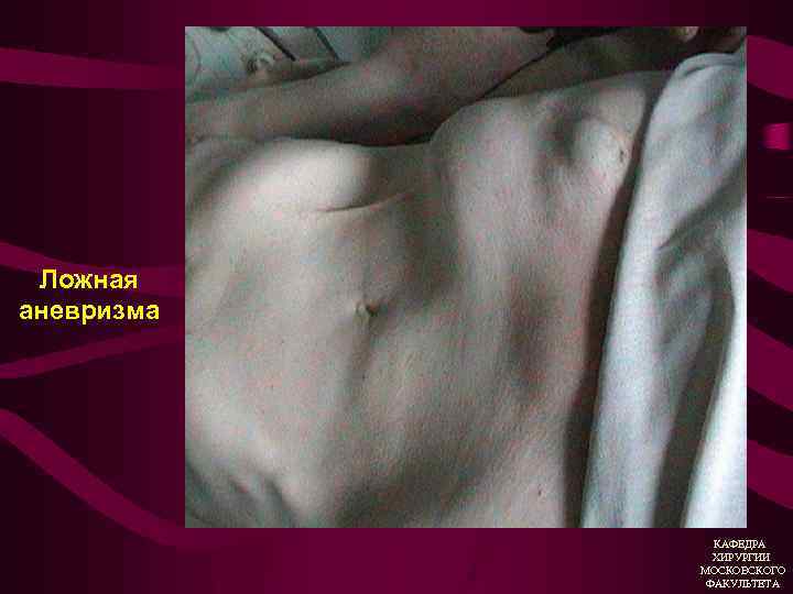 Ложная аневризма КАФЕДРА ХИРУРГИИ МОСКОВСКОГО ФАКУЛЬТЕТА 