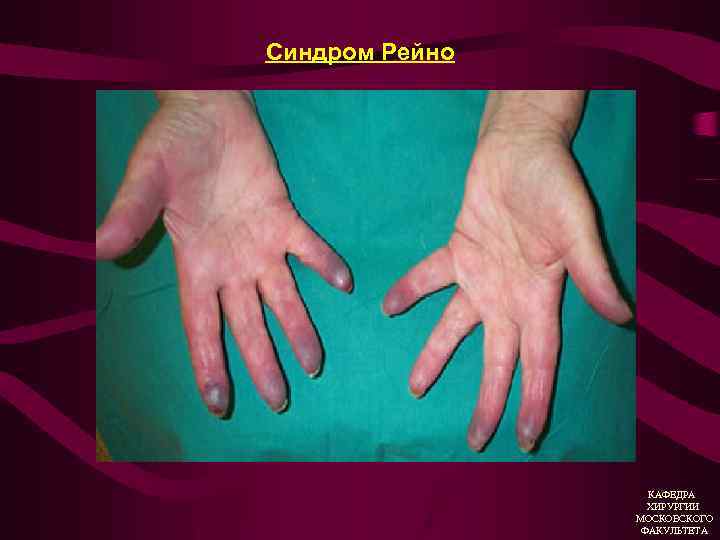 Синдром Рейно КАФЕДРА ХИРУРГИИ МОСКОВСКОГО ФАКУЛЬТЕТА 