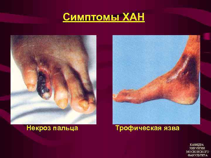 Симптомы ХАН Некроз пальца Трофическая язва КАФЕДРА ХИРУРГИИ МОСКОВСКОГО ФАКУЛЬТЕТА 