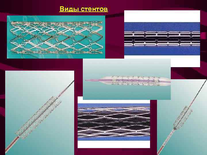 Виды стентов КАФЕДРА ХИРУРГИИ МОСКОВСКОГО ФАКУЛЬТЕТА 