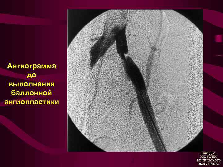 Ангиограмма до выполнения баллонной ангиопластики КАФЕДРА ХИРУРГИИ МОСКОВСКОГО ФАКУЛЬТЕТА 