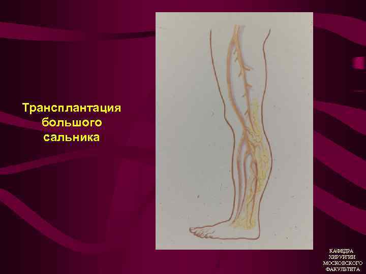 Трансплантация большого сальника КАФЕДРА ХИРУРГИИ МОСКОВСКОГО ФАКУЛЬТЕТА 