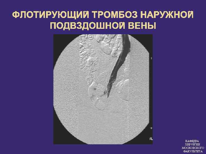 ФЛОТИРУЮЩИЙ ТРОМБОЗ НАРУЖНОЙ ПОДВЗДОШНОЙ ВЕНЫ КАФЕДРА ХИРУРГИИ МОСКОВСКОГО ФАКУЛЬТЕТА 