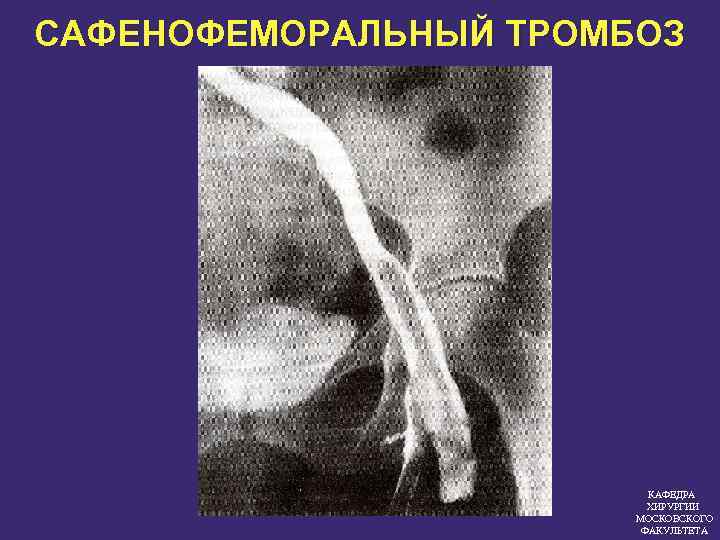 САФЕНОФЕМОРАЛЬНЫЙ ТРОМБОЗ КАФЕДРА ХИРУРГИИ МОСКОВСКОГО ФАКУЛЬТЕТА 