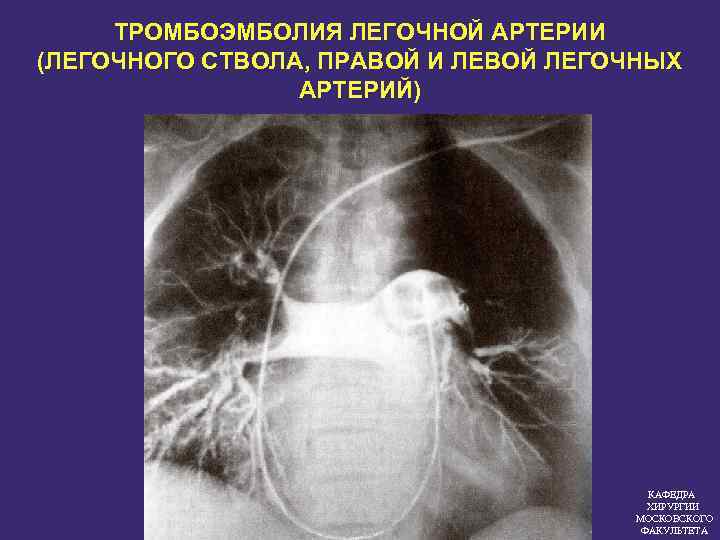 ТРОМБОЭМБОЛИЯ ЛЕГОЧНОЙ АРТЕРИИ (ЛЕГОЧНОГО СТВОЛА, ПРАВОЙ И ЛЕВОЙ ЛЕГОЧНЫХ АРТЕРИЙ) КАФЕДРА ХИРУРГИИ МОСКОВСКОГО ФАКУЛЬТЕТА