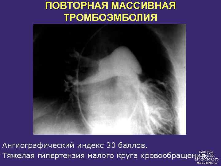 ПОВТОРНАЯ МАССИВНАЯ ТРОМБОЭМБОЛИЯ Ангиографический индекс 30 баллов. КАФЕДРА ХИРУРГИИ Тяжелая гипертензия малого круга кровообращения.