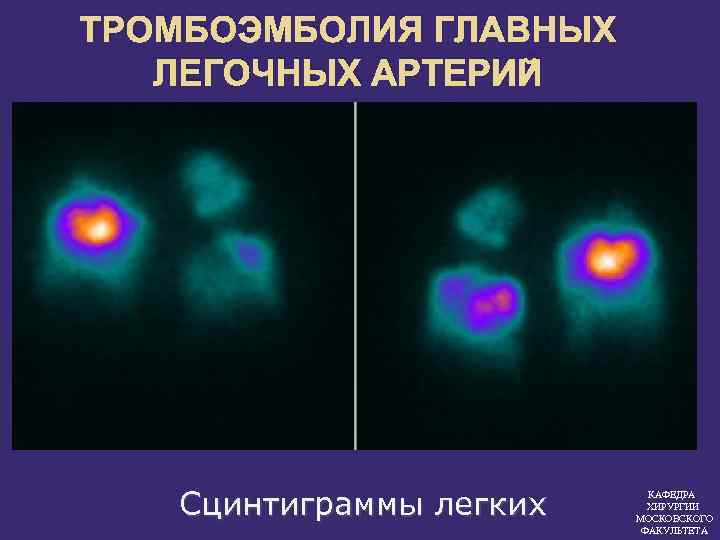 ТРОМБОЭМБОЛИЯ ГЛАВНЫХ ЛЕГОЧНЫХ АРТЕРИЙ Сцинтиграммы легких КАФЕДРА ХИРУРГИИ МОСКОВСКОГО ФАКУЛЬТЕТА 