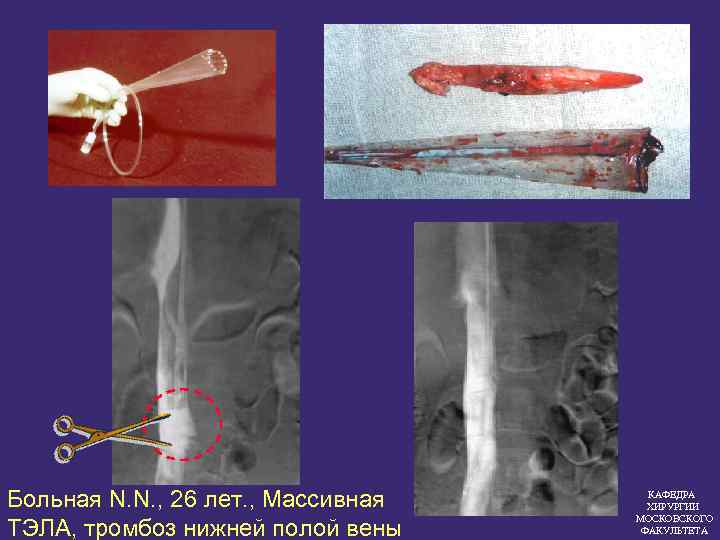 Больная N. N. , 26 лет. , Массивная ТЭЛА, тромбоз нижней полой вены КАФЕДРА
