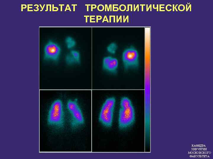 РЕЗУЛЬТАТ ТРОМБОЛИТИЧЕСКОЙ ТЕРАПИИ КАФЕДРА ХИРУРГИИ МОСКОВСКОГО ФАКУЛЬТЕТА 
