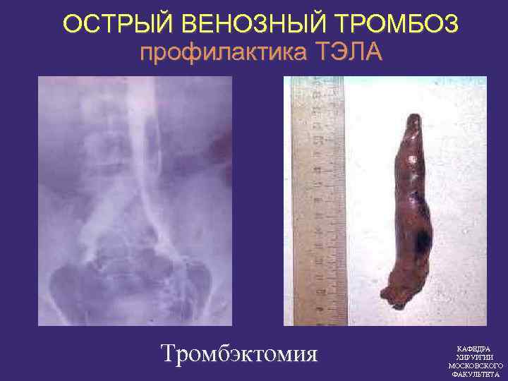 ОСТРЫЙ ВЕНОЗНЫЙ ТРОМБОЗ профилактика ТЭЛА Тромбэктомия КАФЕДРА ХИРУРГИИ МОСКОВСКОГО ФАКУЛЬТЕТА 