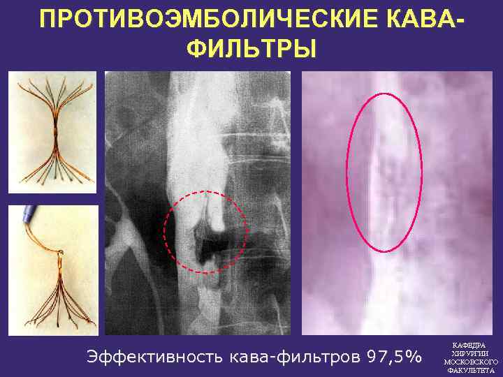 ПРОТИВОЭМБОЛИЧЕСКИЕ КАВАФИЛЬТРЫ Эффективность кава фильтров 97, 5% КАФЕДРА ХИРУРГИИ МОСКОВСКОГО ФАКУЛЬТЕТА 