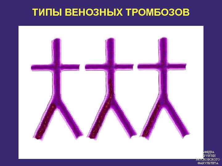ТИПЫ ВЕНОЗНЫХ ТРОМБОЗОВ КАФЕДРА ХИРУРГИИ МОСКОВСКОГО ФАКУЛЬТЕТА 