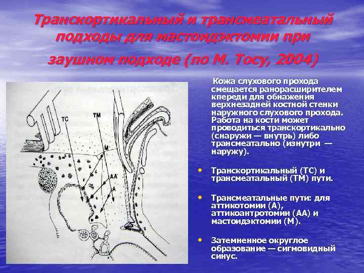 Транскортикальный и трансмеатальный подходы для мастоидэктомии при заушном подходе (по М. Тосу, 2004) Кожа