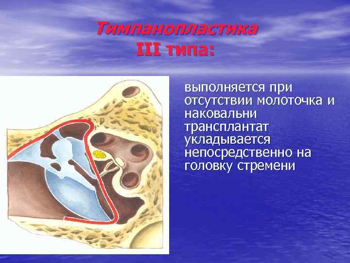 Тимпанопластика III типа: выполняется при отсутствии молоточка и наковальни трансплантат укладывается непосредственно на головку