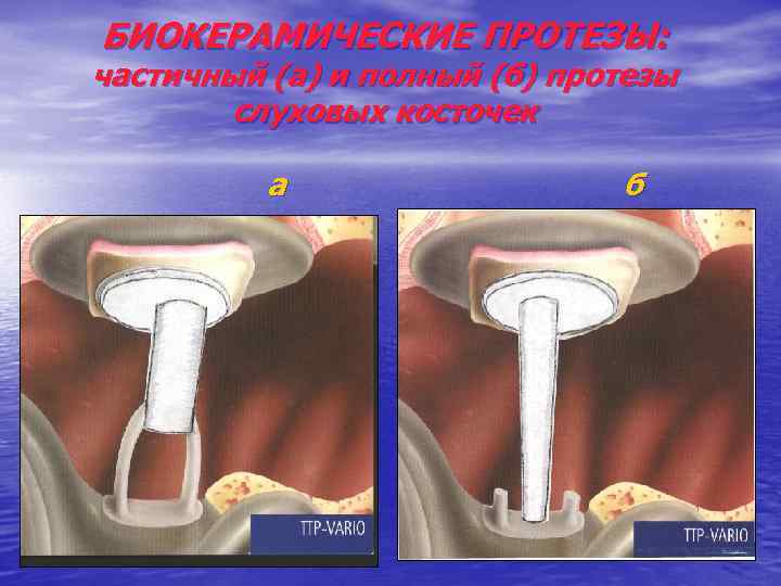 БИОКЕРАМИЧЕСКИЕ ПРОТЕЗЫ: частичный (а) и полный (б) протезы слуховых косточек а б 