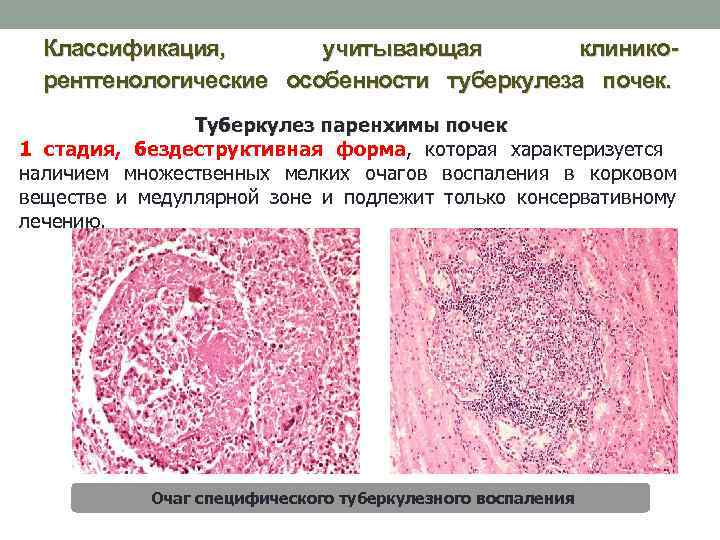 Классификация, учитывающая клиникорентгенологические особенности туберкулеза почек. Туберкулез паренхимы почек 1 стадия, бездеструктивная форма, которая