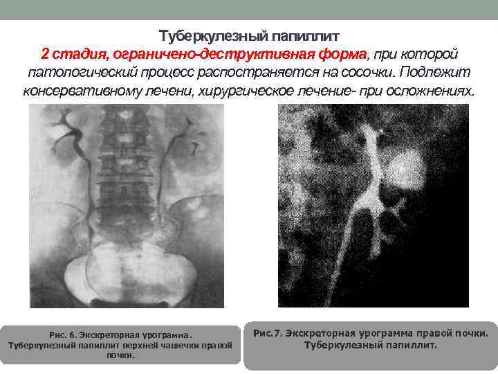 Туберкулезный папиллит 2 стадия, ограничено-деструктивная форма, при которой патологический процесс распостраняется на сосочки. Подлежит