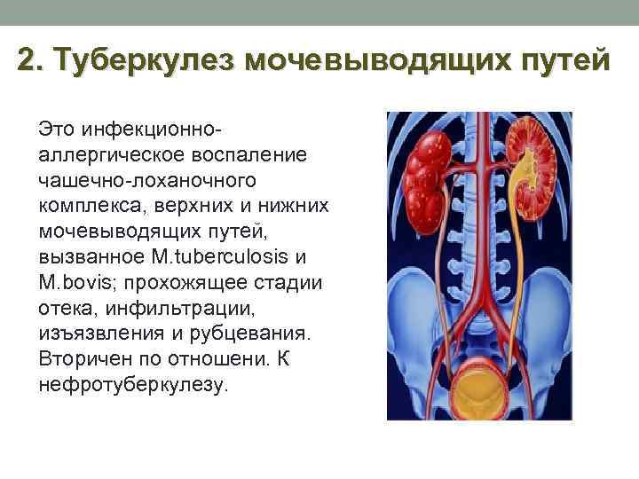 2. Туберкулез мочевыводящих путей Это инфекционноаллергическое воспаление чашечно-лоханочного комплекса, верхних и нижних мочевыводящих путей,