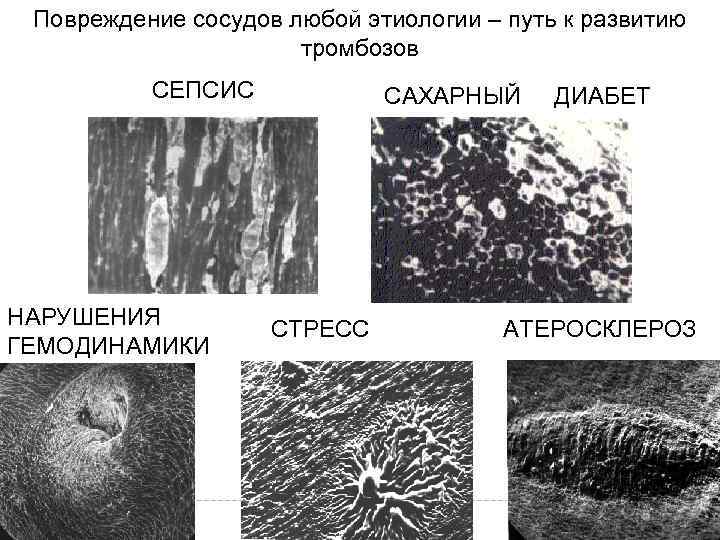 Повреждение сосудов любой этиологии – путь к развитию тромбозов СЕПСИС НАРУШЕНИЯ ГЕМОДИНАМИКИ САХАРНЫЙ ДИАБЕТ
