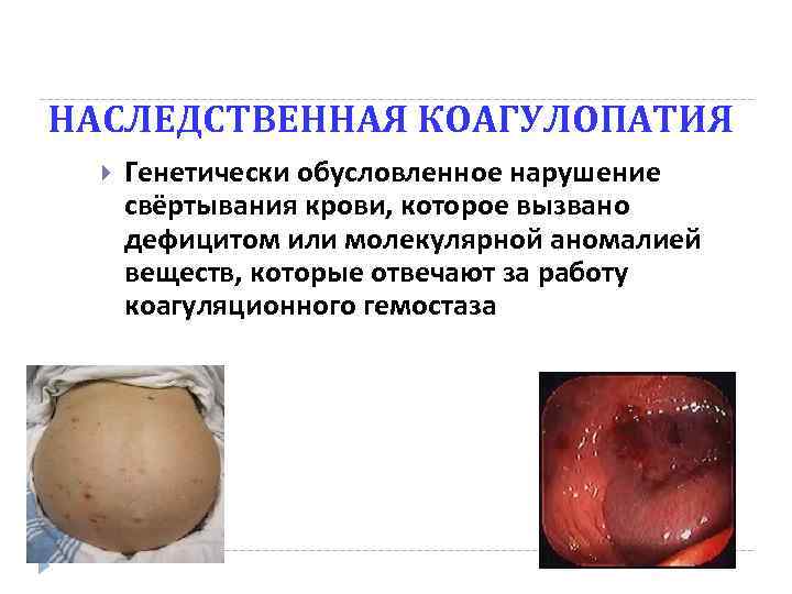 НАСЛЕДСТВЕННАЯ КОАГУЛОПАТИЯ Генетически обусловленное нарушение свёртывания крови, которое вызвано дефицитом или молекулярной аномалией веществ,