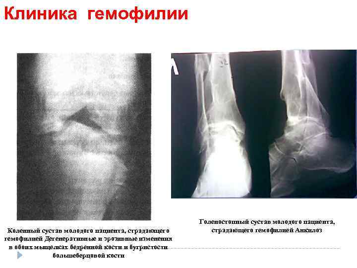 Клиника гемофилии Коленный сустав молодого пациента, страдающего гемофилией Дегенеративные и эрозивные изменения в обоих