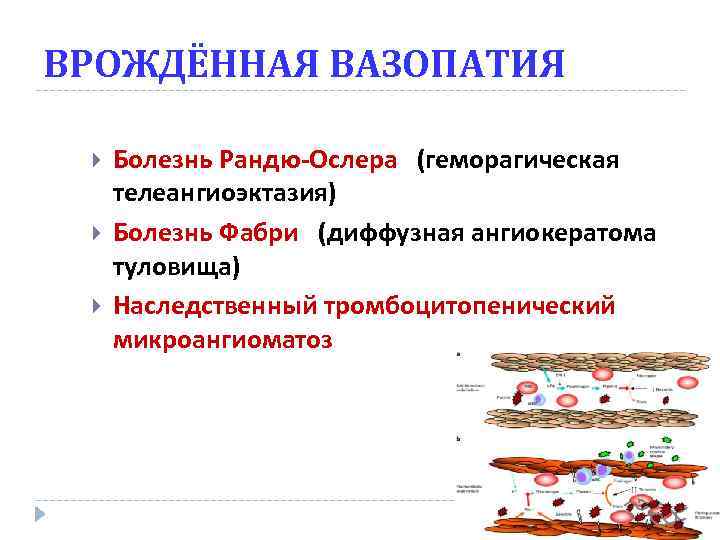 ВРОЖДЁННАЯ ВАЗОПАТИЯ Болезнь Рандю-Ослера (геморагическая телеангиоэктазия) Болезнь Фабри (диффузная ангиокератома туловища) Наследственный тромбоцитопенический микроангиоматоз