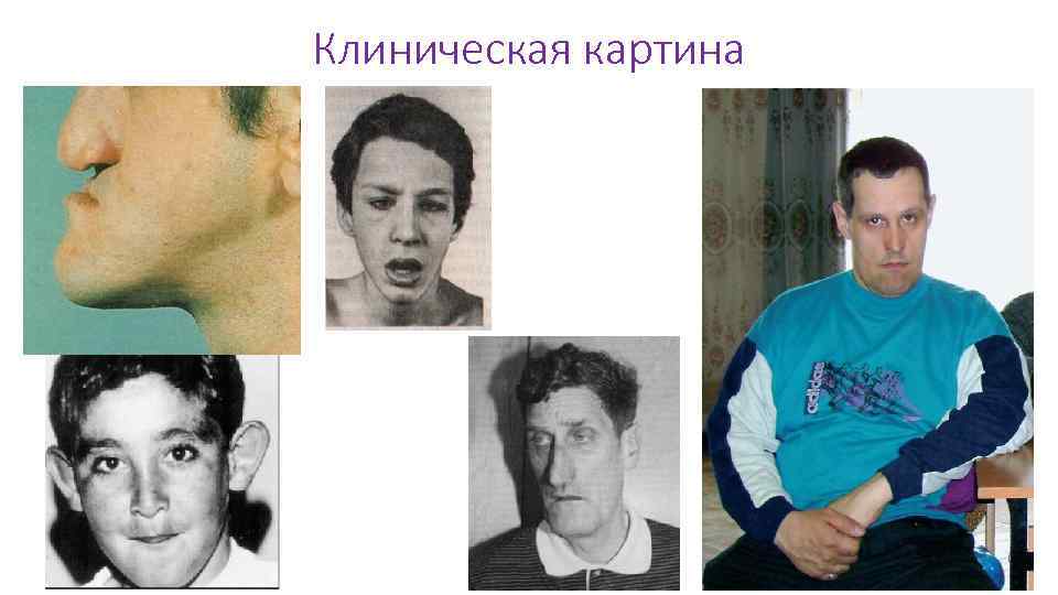 Клиническая картина 