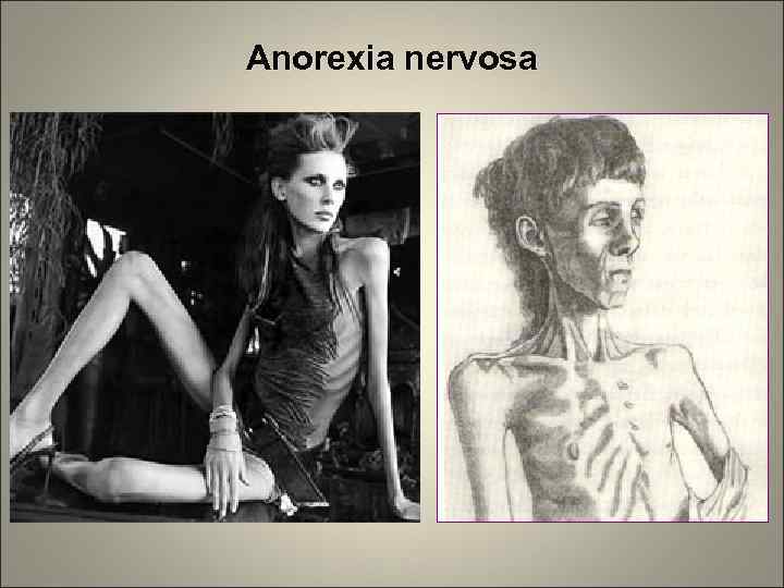 Anorexia nervosa 