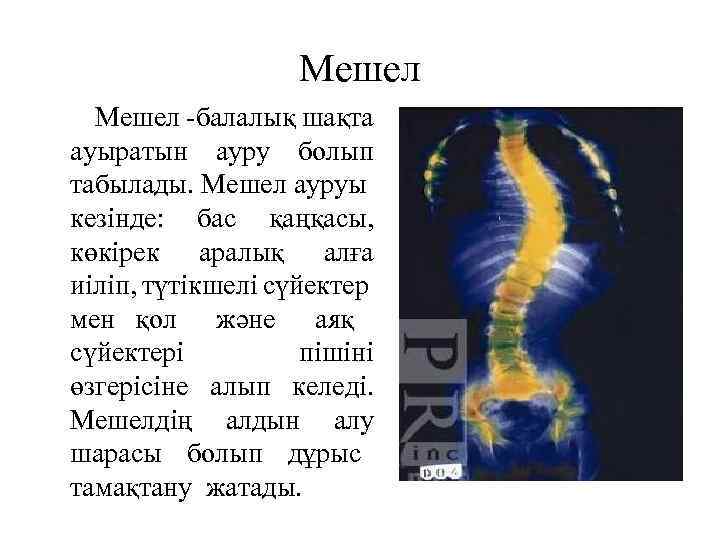 Мешел Мешел балалық шақта ауыратын ауру болып табылады. Мешел ауруы кезінде: бас қаңқасы, көкірек