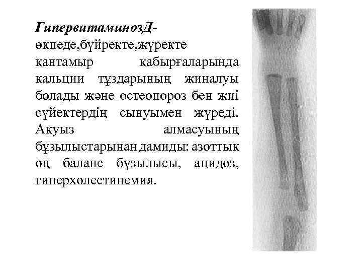Гипервитаминоз. Дөкпеде, бүйректе, жүректе қантамыр қабырғаларында кальции тұздарының жиналуы болады және остеопороз бен жиі