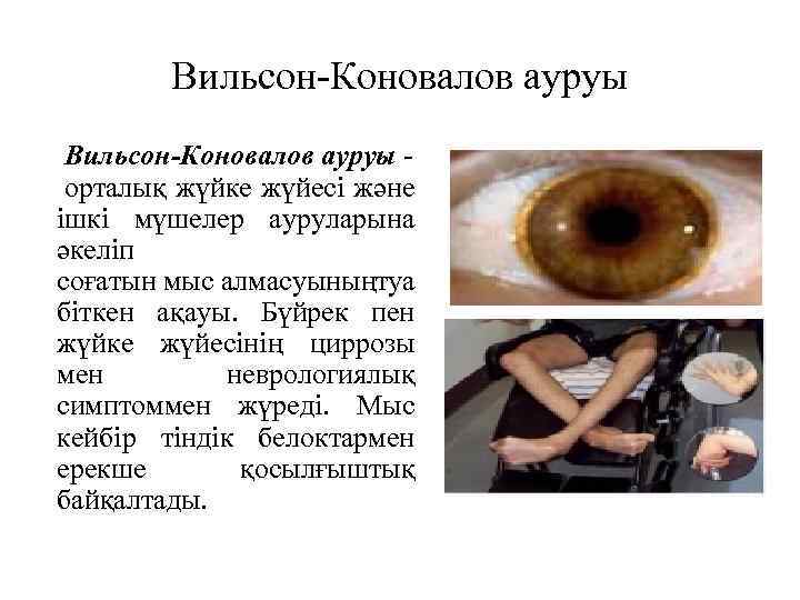 Вильсон Коновалов ауруы Вильсон-Коновалов ауруы орталық жүйке жүйесі және ішкі мүшелер ауруларына әкеліп соғатын