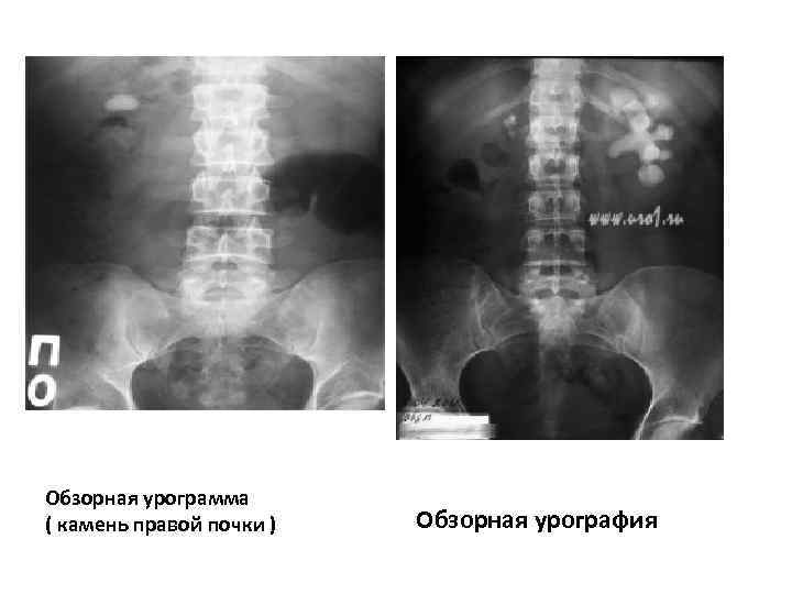 Обзорная урограмма ( камeнь правой почки ) Обзорная урография 