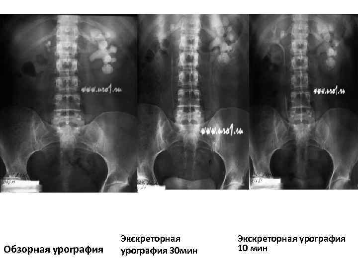 Экскреторная урография картинки